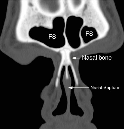 Radiology Anatomy Images CT Frontal Sinuses Anatomy