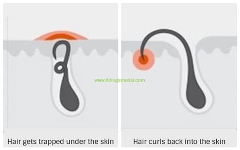 Ingrown hair on labia is an uncomfortable condition for a majority of women. Ingrown Hair on Vagina, Vulva or Labia, Pictures, Causes ...