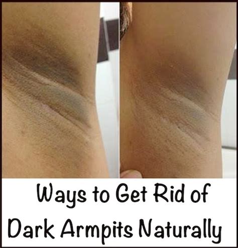 How to lighten dark underarms fast and overnight and also naturally and permanent. Get Rid of Dark Underarms With These 9 Natural Solutions ...