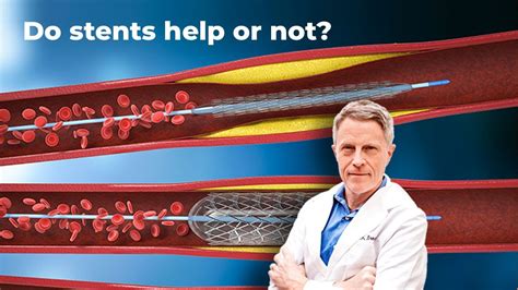 Do Stents Help Or Not Youtube