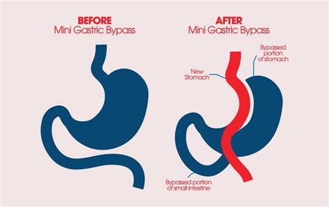 Mini Gastric Bypass Pros And Cons Vida Wellness And Beauty