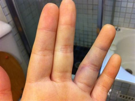 Feb 10, 2019 · jammed finger vs. How To Treat a Jammed Finger | Finger injury, Jammed ...