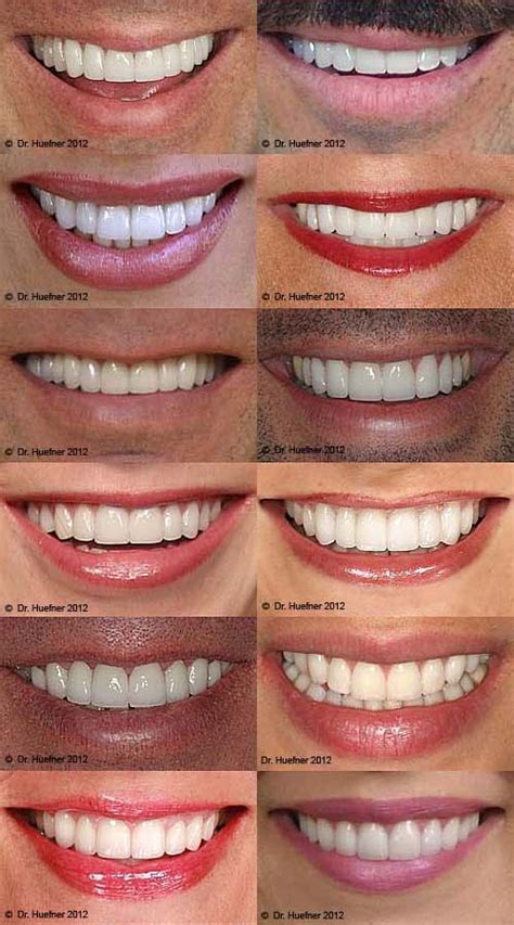 Dental Health Dental Care Smile Dental Smile Teeth Oral Health