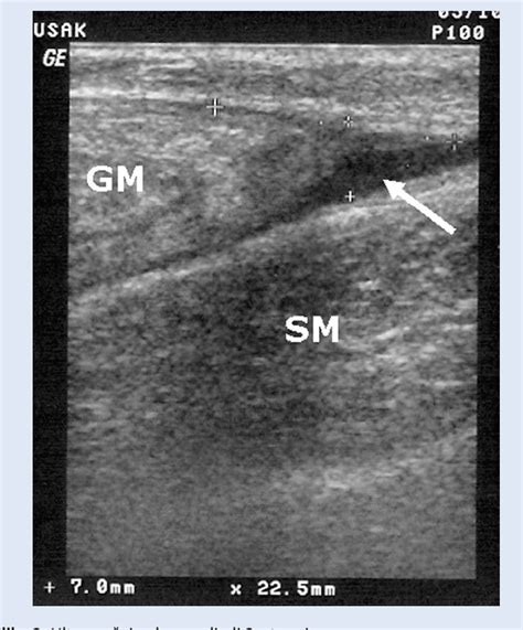 / when the tendon is healed, it will still have a thickened. Figure 1 from Rupture of the medial gastrocnemius head (Tennis leg) - connection between ...
