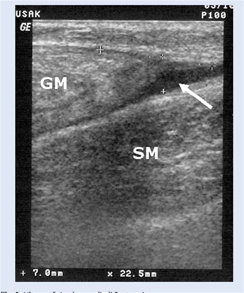 Knock out all these exercises in this order to really feel each muscle of your legs come alive in new ways. Figure 1 from Rupture of the medial gastrocnemius head (Tennis leg) - connection between ...