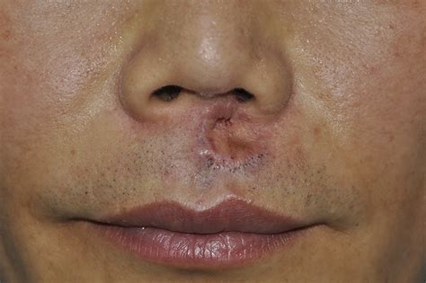 A Preoperative View Of The Upper Lip Shows A Depressed Grafted