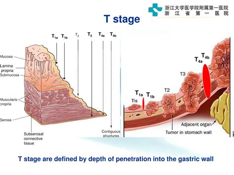 Ppt Gastric Cancer Powerpoint Presentation Free Download Id3429269