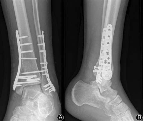 A Postoperative Radiograph Showing Reduction And Fixation Of The