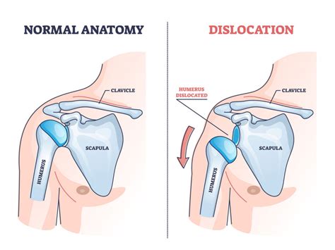 SHOULDER DISLOCATION INSTABILITY Midwest Orthopaedics