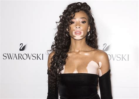 Model With Vitiligo Gets Casted To Walk In Victorias