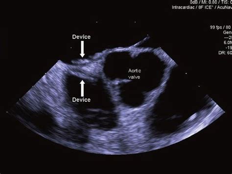The defect size measured by ct was 2.1×0.4 cm, and its distance from the cs ostium was 2.1 cm. Adult Congenital Heart Disease | Thoracic Key