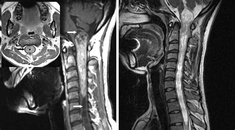 Intramedullary Spinal Cord Tumor The Neurosurgical Atlas