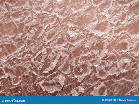 Unhealthy Human Skin Epidermis Texture With Flaking And Cracked Stock