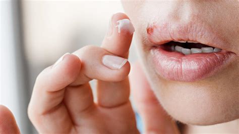 An Lippenherpes Erkrankt Symptome Und Verlauf