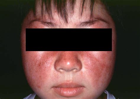 The cause of lupus remains unknown, but there is solid specifically, people with lupus are at an increased risk for atherosclerosis (the deposition of fats and cholesterol plaque. Lupus érythémateux disséminé - Troubles ...