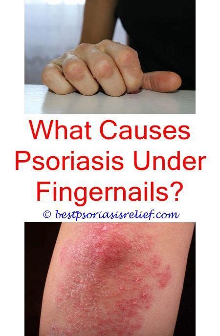 Erythrodermicpsoriasis What Causes Scalp Psoriasis To Flare Up