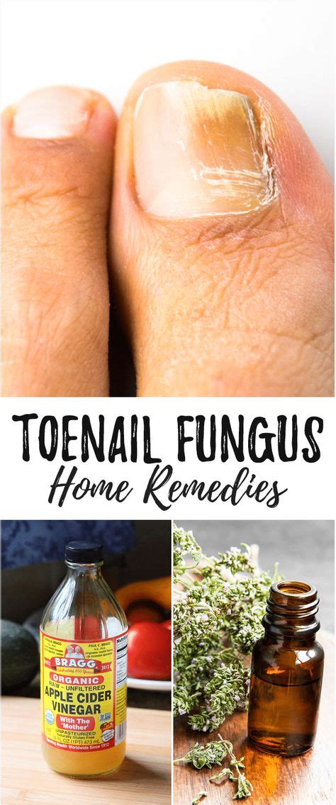 The 25 Best Toenail Fungus Home Remedies Ideas On Pinterest Natural