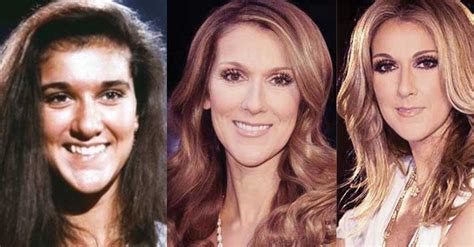 Celine Dion Plastic Surgery Before And After Pictures