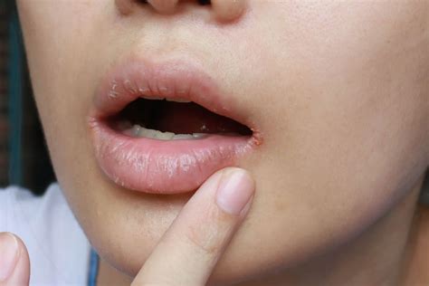 Fungal Infection On Lips And Face