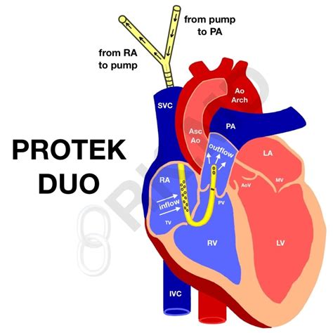 Protekduo Veno Venous Cannula Rkmd