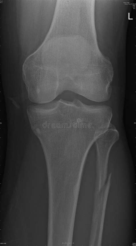 Knee Joint With Fibular Fracture Royalty Free Stock Photography Image