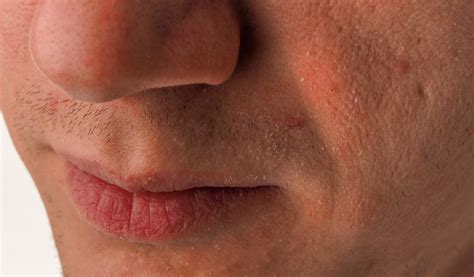 What's good for dry nose. Moisturizer 101: Cara Untuk Memilih Moisturizer Yang Betul ...