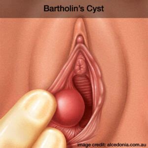 Bartholins Cyst Causes Symptoms Treatment Dr Deepa Ganesh