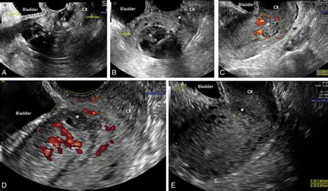 Transvaginal Ultrasound Images Of The Subsequent Steps Of Deflating And