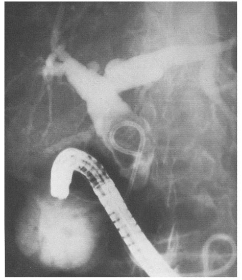 Figure Ercp Showing A 10 French Pigtail Catheter In The Common Bile