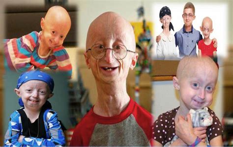 Progeria An Extremely Rare Genetic Aging Disorder Daftsex Hd