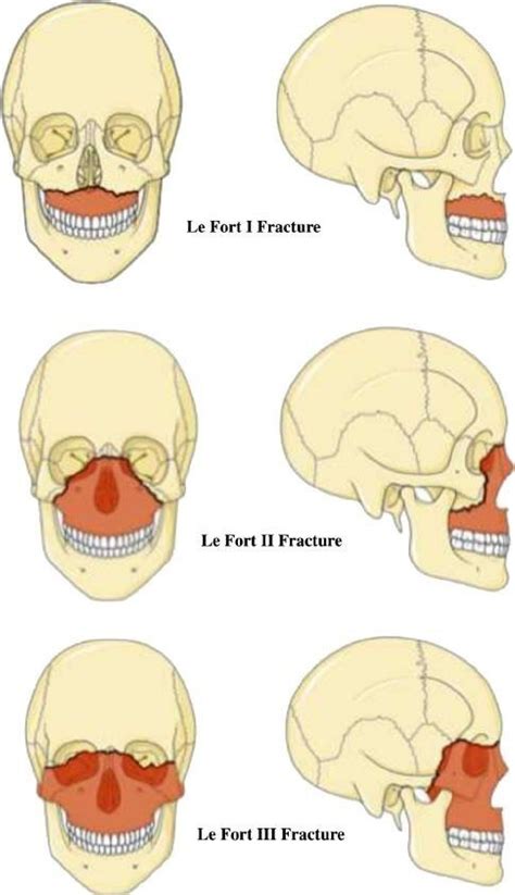 Le Fort type 1: horizontal maxillary fracture, separating ...
