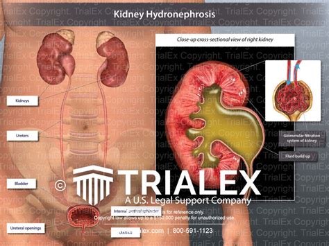 Kidney Hydronephrosis Trialexhibits Inc