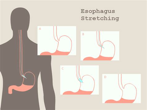 How To Stretch Your Esophagus At Home Kalecyw