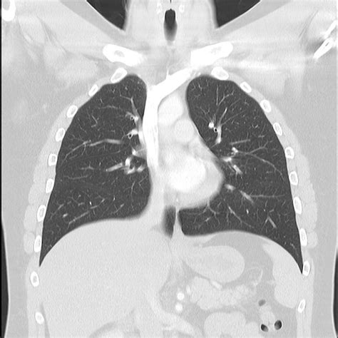 Normal Ct Chest Radiology Case Radiology Chest