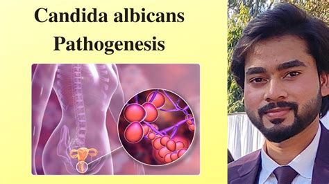 Candida Candida Albicans Candidiasis Pathogenesis By Abhishek