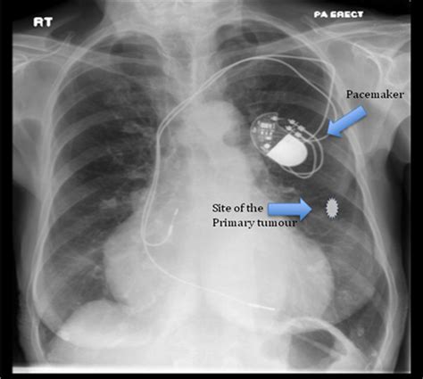Chest X Ray Of The Patient Showing The Pacemaker In Situ And The