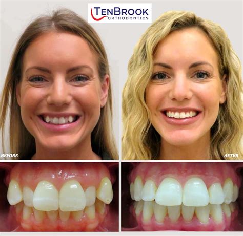 Adult Braces Before And After