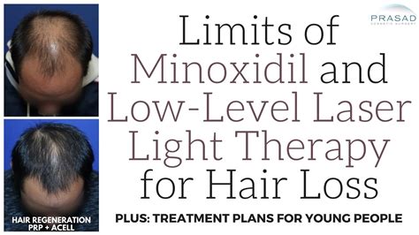 Limits Of Low Level Laser Therapy And Minoxidil For Hair Loss And A