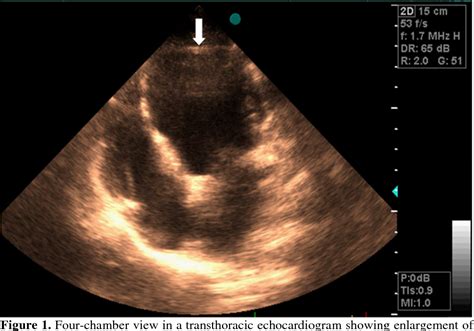 Figure 1 From Left Ventricular Apical Hypoplasia Case Report On