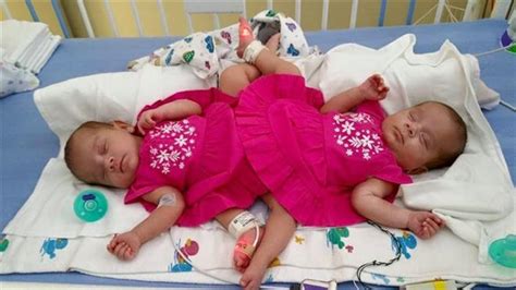 Mom Clings To Faith As Conjoined Twins Undergo Surgery
