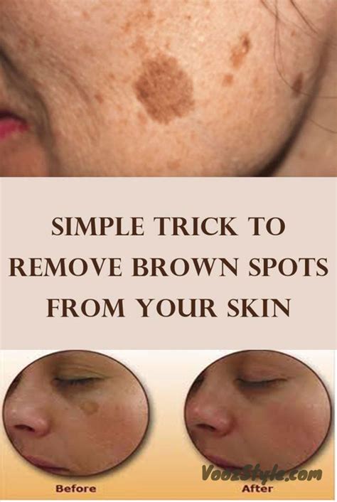 Simple Trick To Remove Brown Spots From Your Skin Spots On Face Age