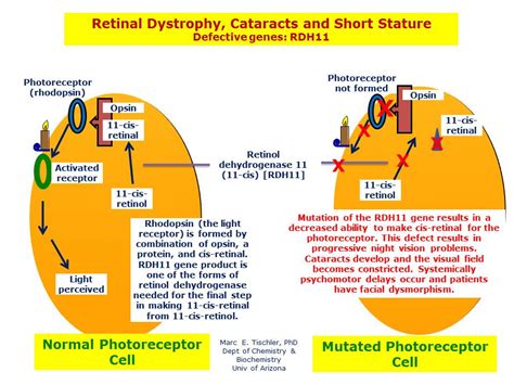 Retinal Dystrophy Cataracts And Short Stature Hereditary Ocular Diseases