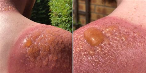 Getting sweat blisters is not uncommon, especially in the heat we are experiencing. This Man's Blistering Burns Proves Why You Should Always ...