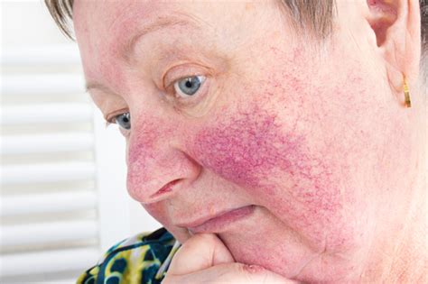 Rosacea Facial Skin Disorder Portrait Of Unhappy Elderly Woman Stock
