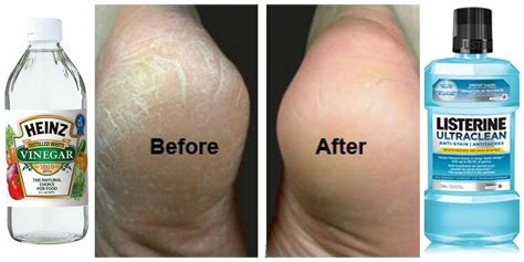 How To Fix Cracked Feet Fast A Homemade Diy Recipe For The Softest Skin Youve Ever Had Dry