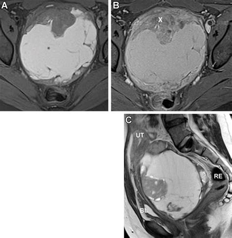 Extraskeletal Ewing Sarcoma From Head To Toe Multimodality Imaging