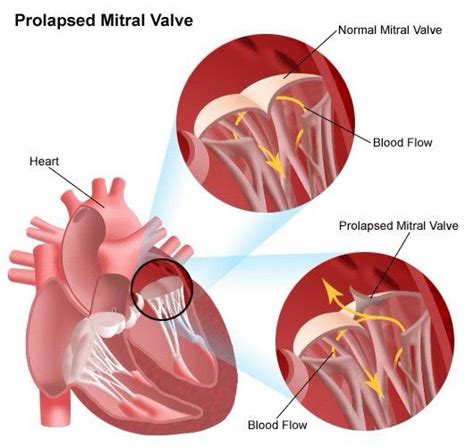 Prolapsed Mitral Valve Prolapso Da Válvula Mitral Cardiovascular Cardio