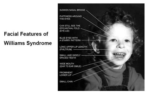 William's syndrome was first recognized as a unique disorder in 1961. Williams Syndrome - Causes, Symptoms, Diagnosis ...