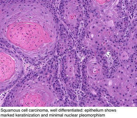 Pathology Outlines Squamous Cell Carcinoma
