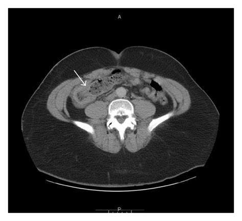 A Computed Tomography Ct Scan Of The Abdomen A Axial Ct Scan At